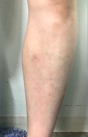 アフターひざ下