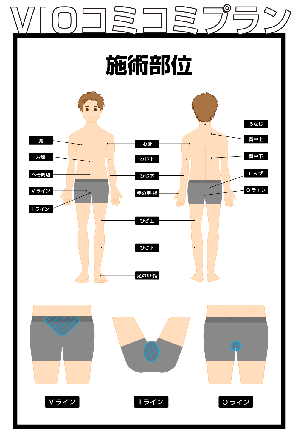VIOコミコミプランの施術部位