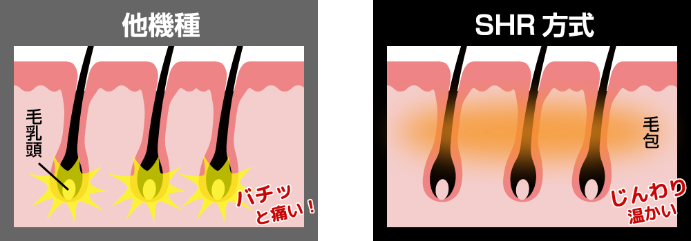 毛包を蓄熱するSHR脱毛
