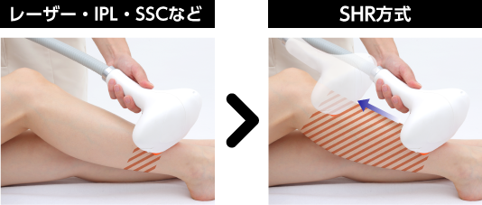 IPL・SHR方式比較